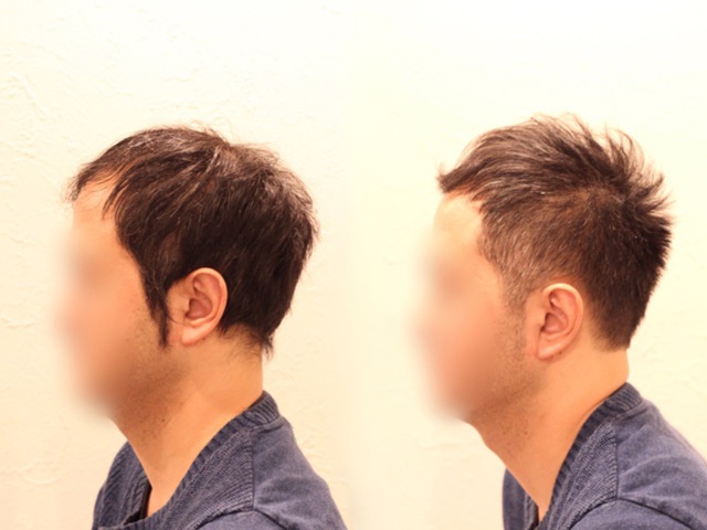 U字・薄毛・残った前髪を生かしてオシャレスポーティな髪型に 悩み別ヘアカタログ 薄毛に悩む男性の為の美容院「INTI[インティ]｜全席